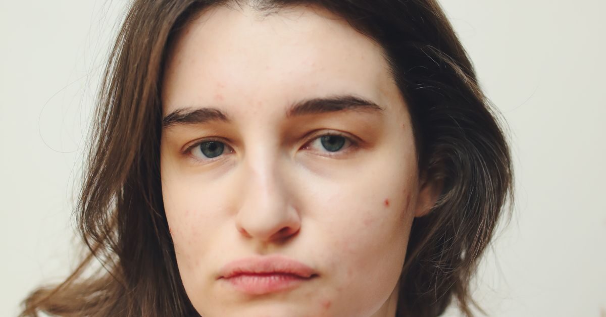 Blackheads Removal: Safe Methods That Actually Work